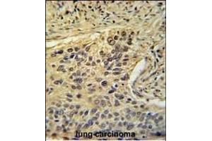 TAF2 Antibody (C-Term) (ABIN653923 and ABIN2843157) immunohistochemistry analysis in formalin fixed and paraffin embedded human lung carcinoma followed by peroxidase conjugation of the secondary antibody and DAB staining.