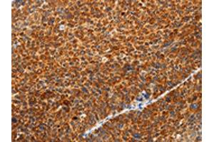 The image on the left is immunohistochemistry of paraffin-embedded Human liver cancer tissue using ABIN7131154(SPATA13 Antibody) at dilution 1/20, on the right is treated with fusion protein. (SPATA13 Antikörper)