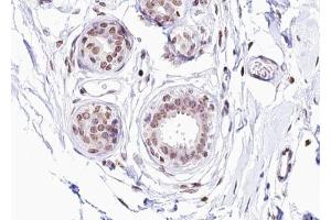 ABIN6267276 at 1/100 staining human Breast carcinoma tissue sections by IHC-P. (Estrogen Receptor alpha Antikörper  (pSer104))