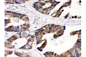 Anti- DLD Picoband antibody, IHC(P) IHC(P): Human Intestinal Cancer Tissue (DLD Antikörper  (AA 300-509))