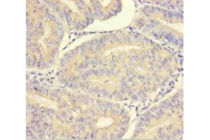 Immunohistochemistry of paraffin-embedded human endometrial cancer using ABIN7165325 at dilution of 1:100 (LMAN1L Antikörper  (AA 26-462))