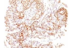 Formalin-fixed, paraffin-embedded human ovarian carcinoma stained with Estrogen Receptor beta antibody (ESR2/686). (ESR2 Antikörper  (C-Term))