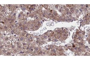ABIN6273970 at 1/100 staining Human liver cancer tissue by IHC-P.
