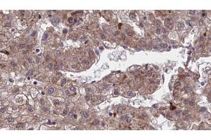 ABIN6273970 at 1/100 staining Human liver cancer tissue by IHC-P. (OR1J4 Antikörper  (C-Term))