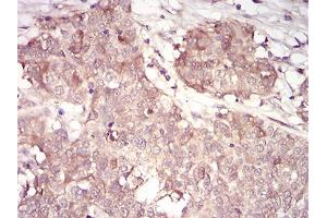 Immunohistochemical analysis of paraffin-embedded bladder cancer tissues using CCNA2 mouse mAb with DAB staining.