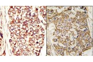 (LEFT)Formalin-fixed and paraffin-embedded human cancer tissue reacted with the primary antibody, which was peroxidase-conjugated to the secondary antibody, followed by AEC staining. (ErbB2/Her2 Antikörper  (N-Term))