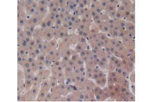 IHC-P analysis of Human Liver Cancer Tissue, with DAB staining. (ALT Antikörper  (AA 255-496))