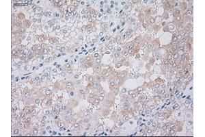 Immunohistochemical staining of paraffin-embedded Carcinoma of kidney tissue using anti-KRT19mouse monoclonal antibody. (Cytokeratin 19 Antikörper  (AA 240-390))