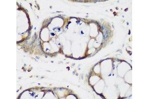 Immunohistochemistry of paraffin-embedded Human gastric using MTDH Polyclonal Antibody at dilution of 1:200 (40x lens). (MTDH Antikörper)