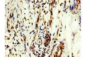 IHC image of ABIN7160441 diluted at 1:300 and staining in paraffin-embedded human bladder cancer performed on a Leica BondTM system. (MYT1 Antikörper  (AA 317-451))