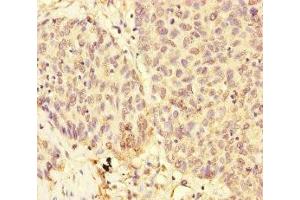 Immunohistochemistry of paraffin-embedded human ovarian cancer using ABIN7174302 at dilution of 1:100