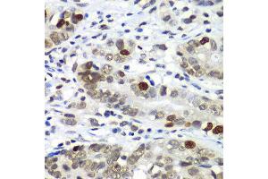 Immunohistochemistry of paraffin-embedded human gastric cancer using DR1 antibody at dilution of 1:100 (x40 lens). (DR1 Antikörper)