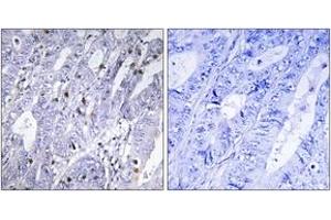 Immunohistochemistry analysis of paraffin-embedded human colon carcinoma tissue, using MEF2D (Ab-444) Antibody.