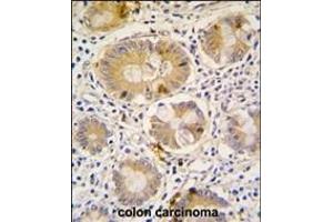 Formalin-fixed and paraffin-embedded human colon carcinoma tissue reacted with Autophagy G16L antibody (C-term), which was peroxidase-conjugated to the secondary antibody, followed by DAB staining. (ATG16L1 Antikörper  (C-Term))