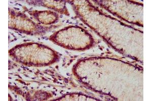 IHC image of ABIN7151176 diluted at 1:800 and staining in paraffin-embedded human gastric cancer performed on a Leica BondTM system. (RNF213 Antikörper  (AA 202-350))