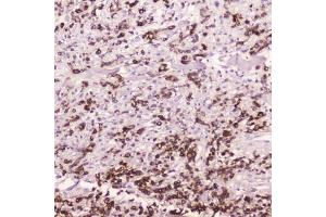 IHC testing of FFPE human gastric cancer with Cathepsin E antibody at 2ug/ml. (Cathepsin E Antikörper  (AA 150-393))