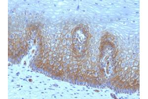 Formalin-fixed, paraffin-embedded human Cervical Carcinoma stained with Thrombomodulin / CD141 Monoclonal Antibody (rTHBD/1591). (Rekombinanter Thrombomodulin Antikörper  (AA 69-194))