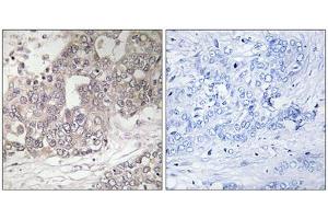 Immunohistochemistry analysis of paraffin-embedded human liver carcinoma tissue using ATG4C antibody. (ATG4C Antikörper  (N-Term))