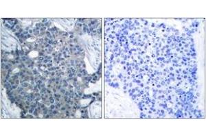 Immunohistochemistry analysis of paraffin-embedded human breast carcinoma tissue, using Stathmin 1 (Ab-24) Antibody. (Stathmin 1 Antikörper  (AA 9-58))