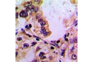 Immunohistochemical analysis of PABPC5 staining in human lung cancer formalin fixed paraffin embedded tissue section. (PABPC5 Antikörper)
