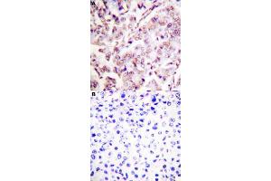 Immunohistochemical staining (Formalin-fixed paraffin-embedded sections) of human breast cancer tissue with ETS1 (phospho T38) polyclonal antibody  without blocking peptide (A) or preincubated with blocking peptide (B) under 1:50-1:100 dilution.