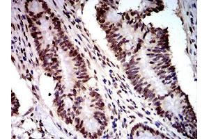 Immunohistochemical analysis of paraffin-embedded colon cancer tissues using DDX1 mouse mAb with DAB staining. (DDX1 Antikörper  (AA 642-740))