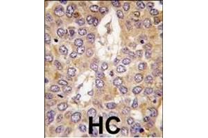 Formalin-fixed and paraffin-embedded human hepatocarcinoma tissue reacted with CK1g2 antibody (C-term), which was peroxidase-conjugated to the secondary antibody, followed by DAB staining.