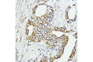 Immunohistochemistry of paraffin-embedded human lung cancer using SOCS6 antibody (ABIN6128785, ABIN6148273, ABIN6148274 and ABIN6225294) at dilution of 1:100 (40x lens). (SOCS6 Antikörper  (AA 1-210))