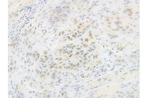 ABIN6260348 and ABIN6269272 at 1/100 staining human tongue carcinoma by IHC-P. (CEBPA Antikörper  (N-Term))