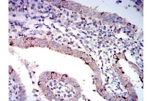 Immunohistochemical analysis of paraffin-embedded endometrial cancer tissues using BAX mouse mAb with DAB staining. (BAX Antikörper  (AA 13-160))