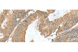 Immunohistochemistry of paraffin-embedded Human colorectal cancer tissue using RAB23 Polyclonal Antibody at dilution of 1:50(x200) (RAB23 Antikörper)
