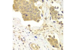 Immunohistochemistry of paraffin-embedded Human mammary cancer using GABARAP antibody at dilution of 1:100 (x400 lens). (GABARAP Antikörper)