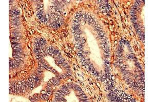 Immunohistochemistry analysis of human colon cancer using ABIN7176531 at dilution of 1:100 (ZNF791 Antikörper  (AA 1-250))