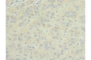 Immunohistochemistry of paraffin-embedded human liver cancer using ABIN7159816 at dilution of 1:100 (OGN Antikörper  (AA 20-298))