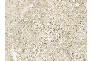 PCGF1 Mouse Monoclonal Antibody at 1/100 staining human esophageal cancer and adjacent non-tumor tissue by IHC-P. (PCGF1 Antikörper)