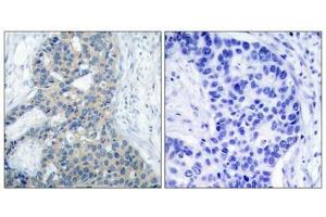 Immunohistochemical analysis of paraffin-embedded human breast carcinoma tissue using Stathmin 1(Phospho-Ser38) Antibody(left) or the same antibody preincubated with blocking peptide(right). (Stathmin 1 Antikörper  (pSer38))