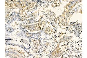 DKK1 Mouse Monoclonal Antibody at 1/100 staining human pancreatic cancer by IHC-P. (DKK1 Antikörper  (Internal Region))