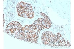 Formalin-fixed, paraffin-embedded human breast carcinoma stained with Calprotectin Mouse Monoclonal Antibody (S100A9/1075).