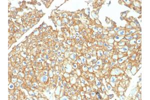 Formalin-fixed, paraffin-embedded human Renal Cell Carcinoma stained with EpCAM Rabbit Polyclonal Antibody. (EpCAM Antikörper)