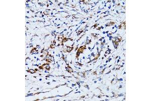 Immunohistochemistry of paraffin-embedded human uterine cancer using RARS antibody (ABIN5973728) at dilution of 1/100 (40x lens). (RARS Antikörper)