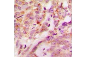 Immunohistochemical analysis of Laminin alpha 4 staining in human breast cancer formalin fixed paraffin embedded tissue section. (LAMa4 Antikörper  (Center))