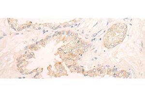 Immunohistochemistry of paraffin-embedded Human prost ate cancer tissue using ELANE Polyclonal Antibody at dilution of 1:25(x200) (ELANE Antikörper)
