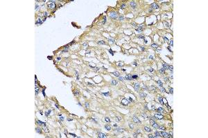 Immunohistochemistry of paraffin-embedded human prostate cancer using ASIP antibody (ABIN5974140) at dilution of 1/100 (40x lens). (ASIP Antikörper)