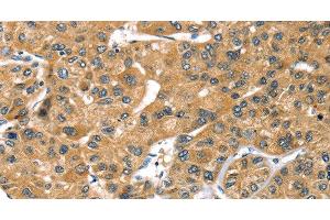 Immunohistochemistry of paraffin-embedded Human liver cancer using PRSS50 Polyclonal Antibody at dilution of 1:30 (PRSS50 Antikörper)