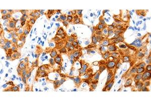 Immunohistochemistry of paraffin-embedded Human lung cancer tissue using SLC2A11 Polyclonal Antibody at dilution 1:140 (SLC2A11 Antikörper)