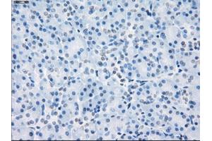 Immunohistochemical staining of paraffin-embedded Adenocarcinoma of colon tissue using anti-LTA4Hmouse monoclonal antibody. (LTA4H Antikörper)