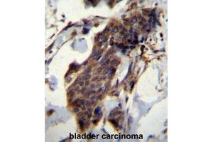 CCDC13 Antibody (N-term) immunohistochemistry analysis in formalin fixed and paraffin embedded human bladder carcinoma followed by peroxidase conjugation of the secondary antibody and DAB staining.