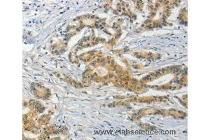 Immunohistochemistry of Human colon cancer using ASB8 Polyclonal Antibody at dilution of 1:50 (ASB8 Antikörper)