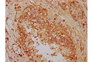 IHC image of ABIN7165406 diluted at 1:300 and staining in paraffin-embedded human prostate cancer performed on a Leica BondTM system. (FAM13A Antikörper  (AA 1-201))