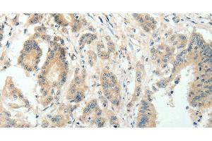 Immunohistochemistry of paraffin-embedded Human colon cancer using SIRT3 Polyclonal Antibody at dilution of 1:30 (SIRT3 Antikörper)